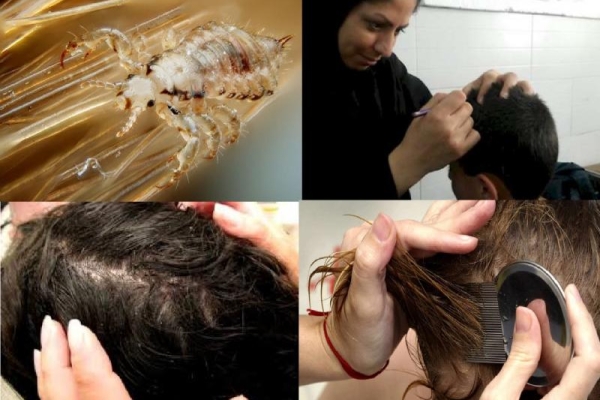 وقتی عدم رعایت بهداشت فردی بهداشت اجتماعی مدارس را به خطر می اندازد / لزوم استفاده دانش آموزان از شامپوهای پرمترین 