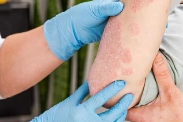 عوامل مؤثر در تشدید علائم بیماری پسوریازیس