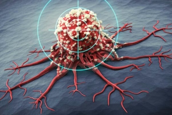 شیوع بالای سرطان‌های گوارش و پستان در کرمانشاه