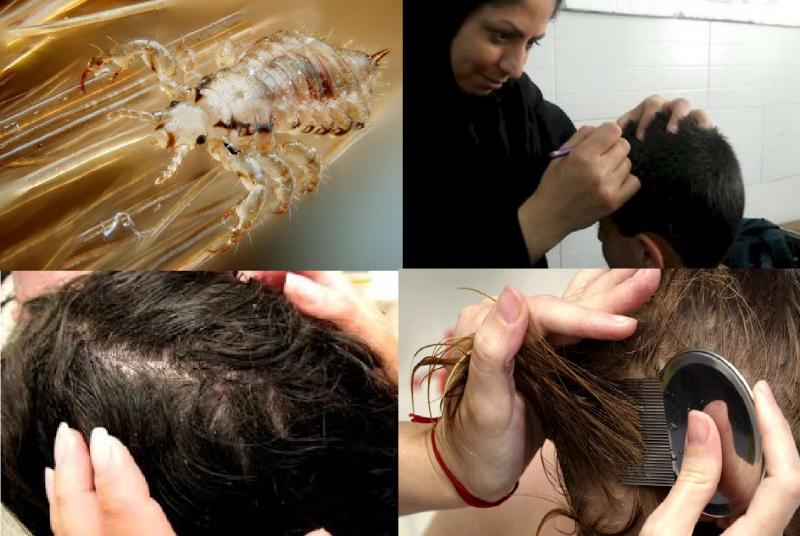 وقتی عدم رعایت بهداشت فردی بهداشت اجتماعی مدارس را به خطر می اندازد / لزوم استفاده دانش آموزان از شامپوهای پرمترین 