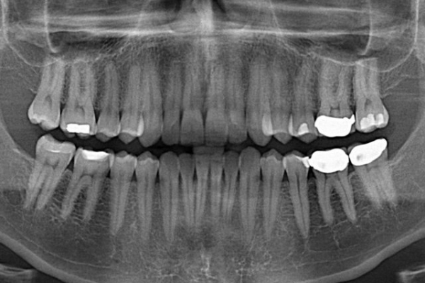 خطر پرتوگیری‌های پزشکی غیرضرور / اهمیت «تیروئید بند سربی» در رادیولوژی‌ دندانی